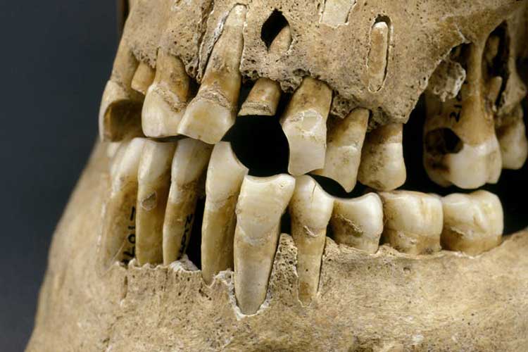 انسان‌های اولیه هم دچار مشکلات دندان مشابه ما می‌شده‌اند