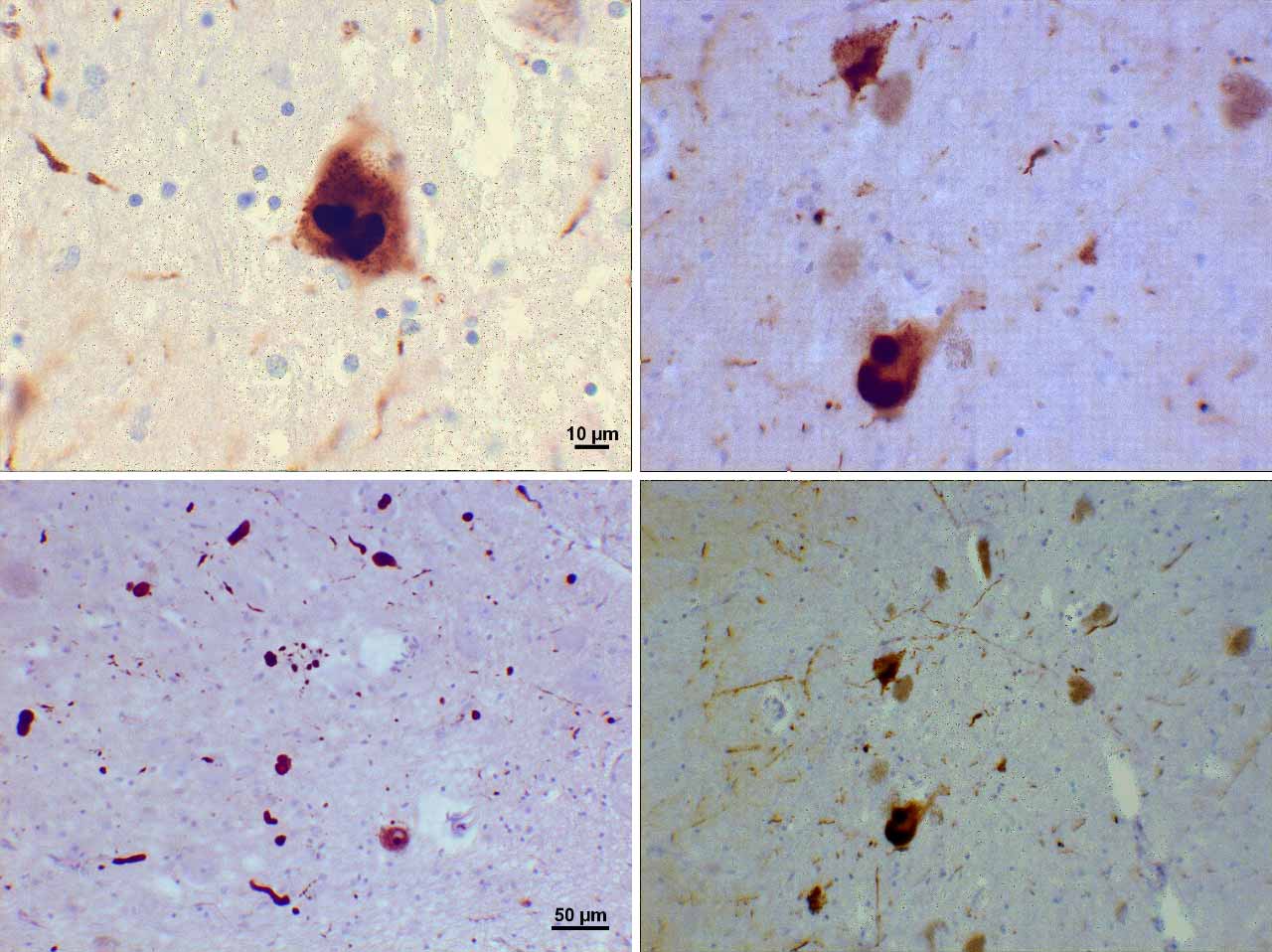 زوال عقل / dementia