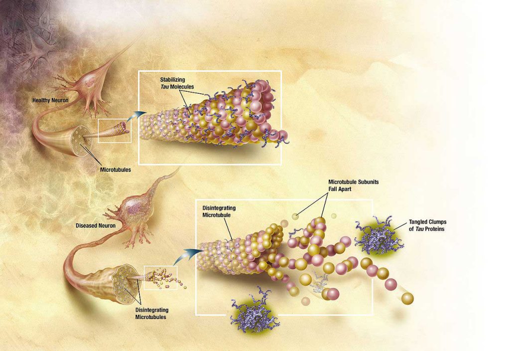 آسیب شناسی آلزایمر / alzheimer pathology