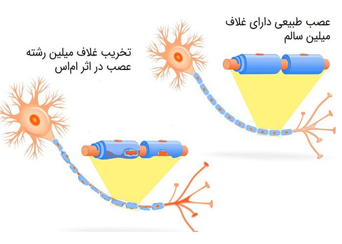 تاثیر ام اس روی غلاف میلین رشته عصبی