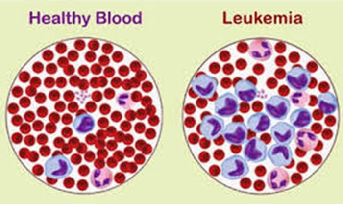 سلول های لوکمیایی