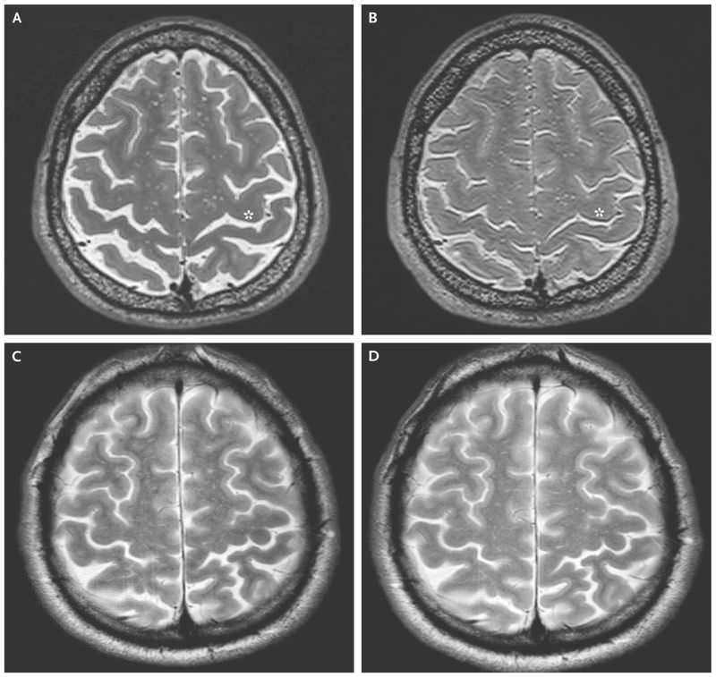 اسکن مغز فضانوردان / Astronauts Brain Scan